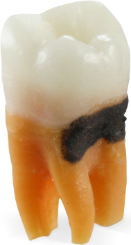 Perio Replacement Teeth with SimCalc™